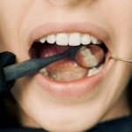 tonsillitis treatment private 2025