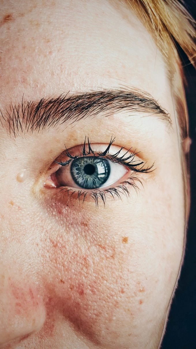 Patient undergoing laser eye surgery in a private UK clinic