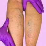 varicose veins on legs image 2025