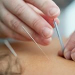 Acupuncture & UK Health Insurance