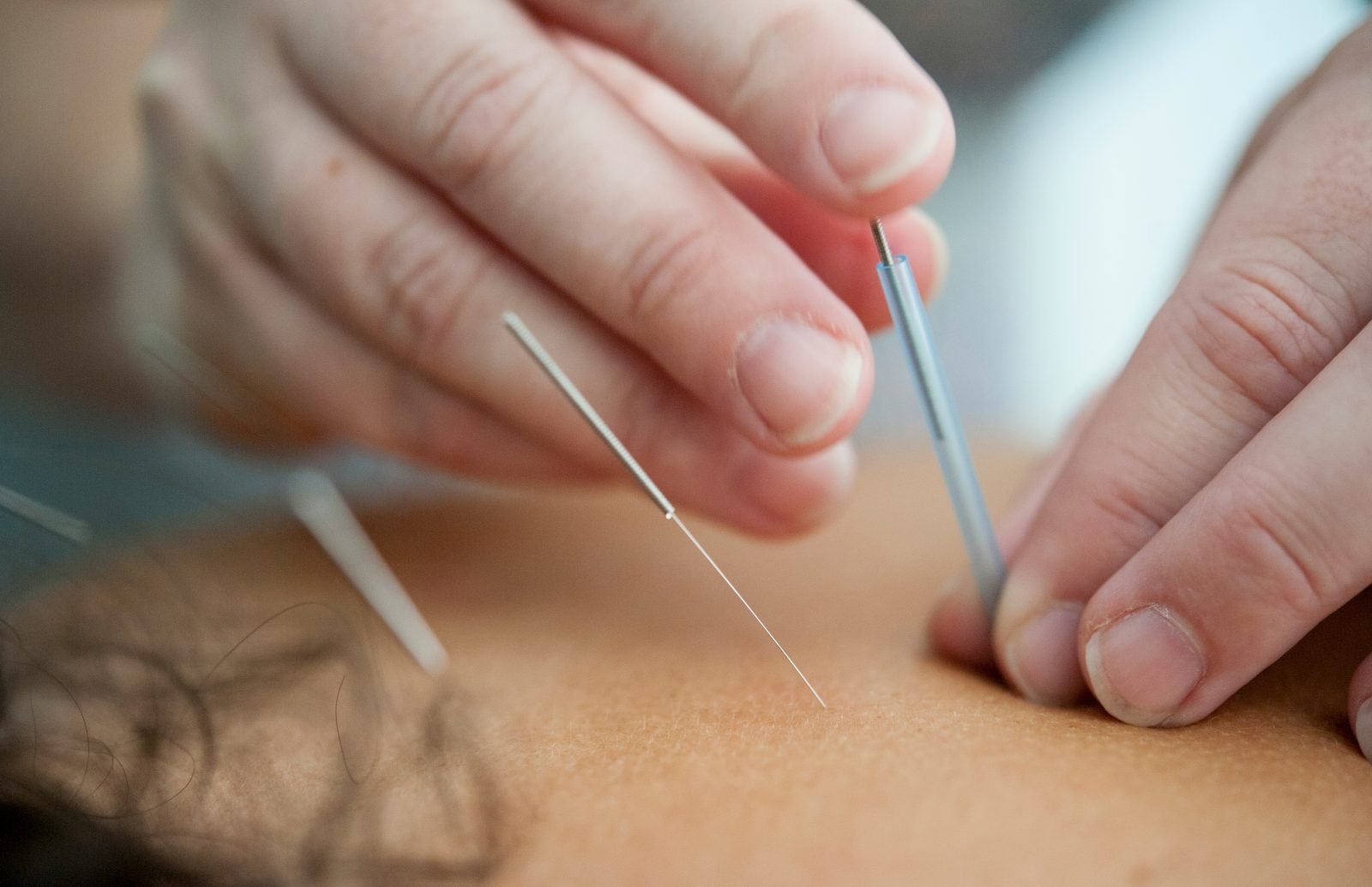 Acupuncture & UK Health Insurance